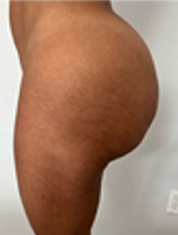 Procedure before and after - before