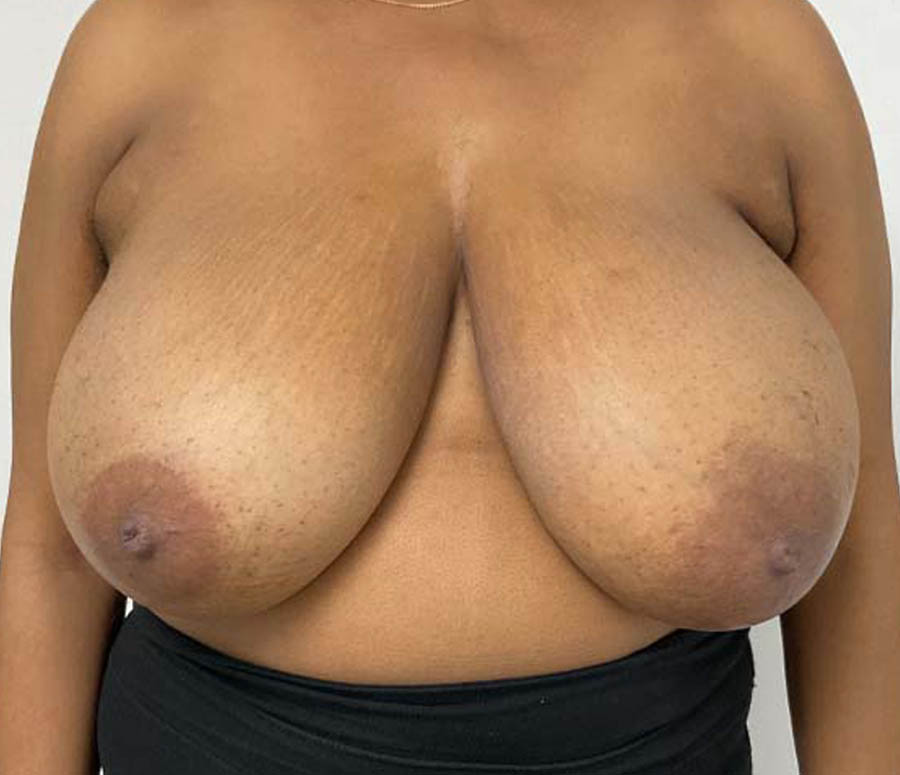 Breast Reduction before and after - before