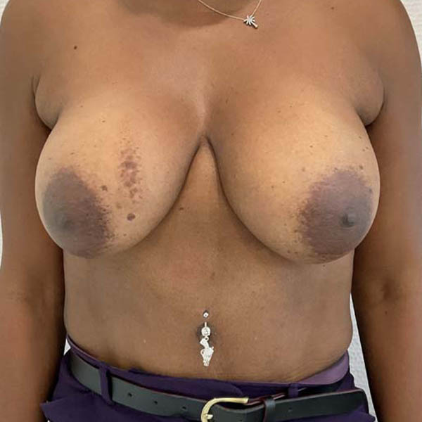 Breast Augmentation before and after - before