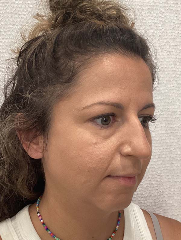 Rhinoplasty before and after - before