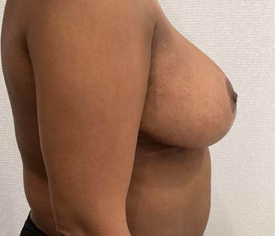 Breast Reduction before and after - after