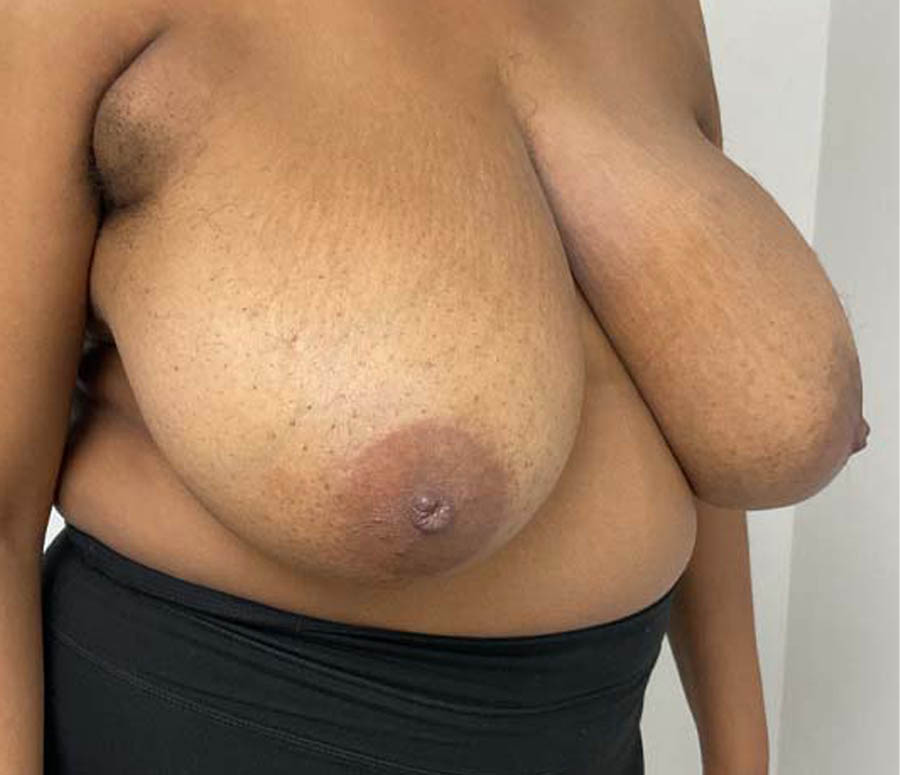 Breast Reduction before and after - before