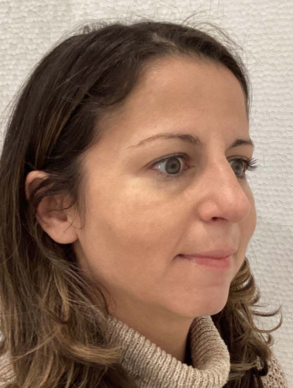 Rhinoplasty before and after - after