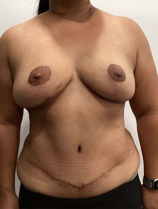 Mommy Makeover before and after - after