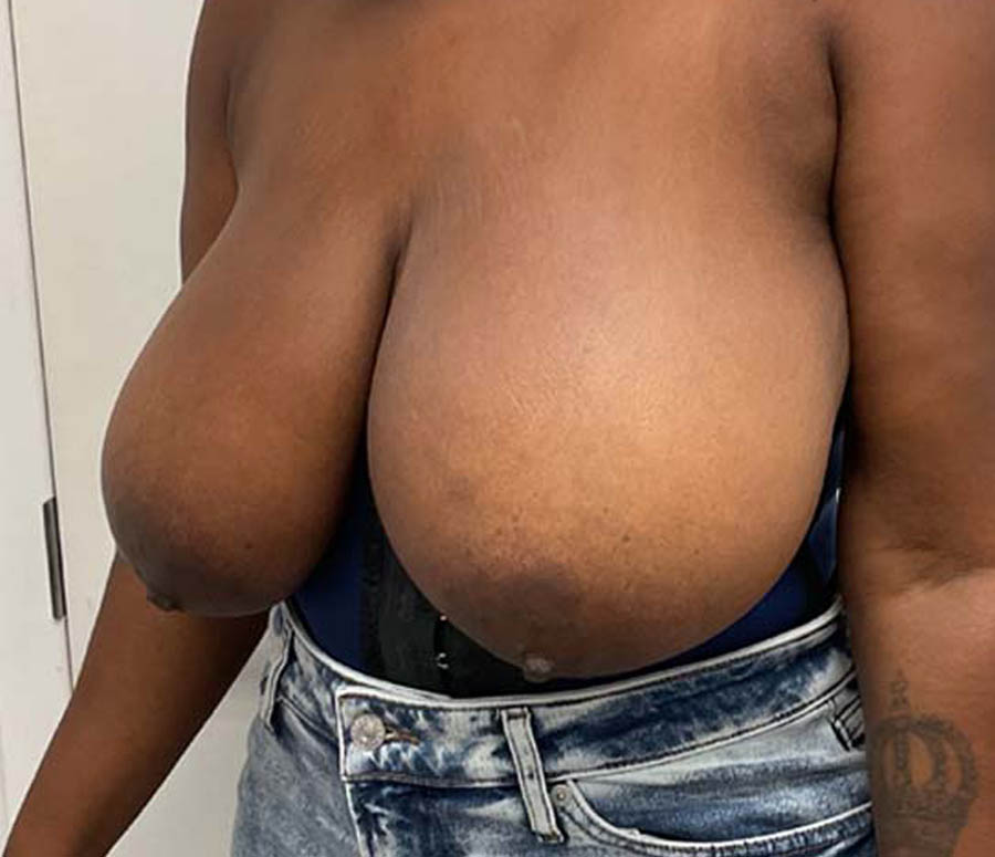 Breast Reduction before and after - before