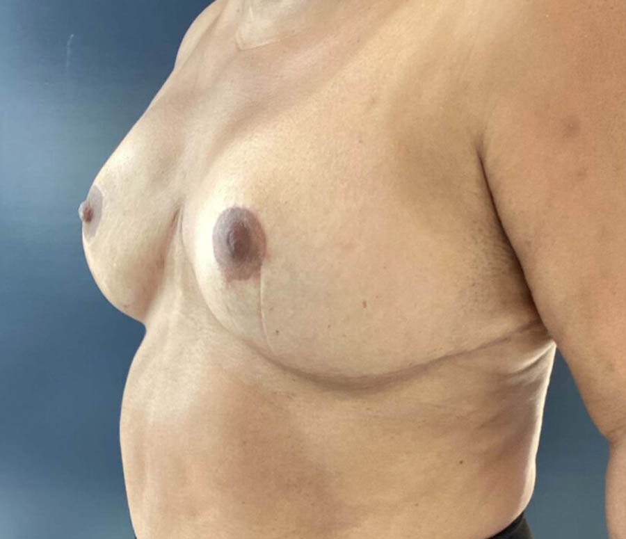 Breast Reduction before and after - after