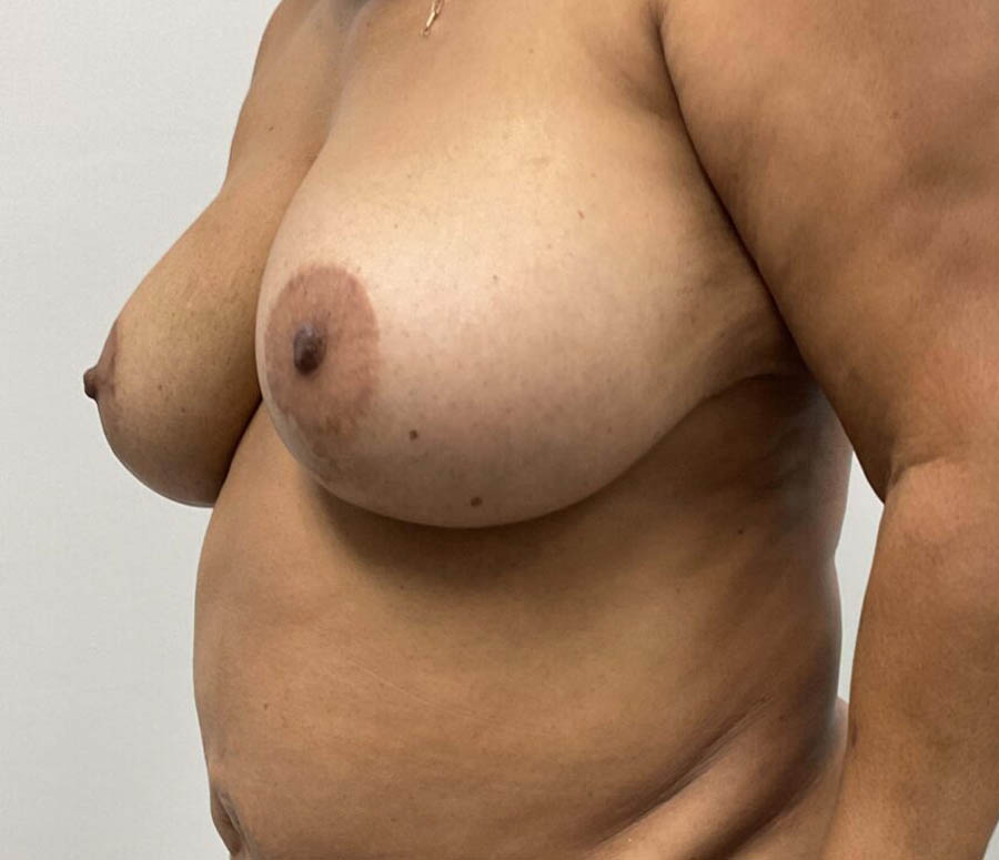 Breast Reduction before and after - before