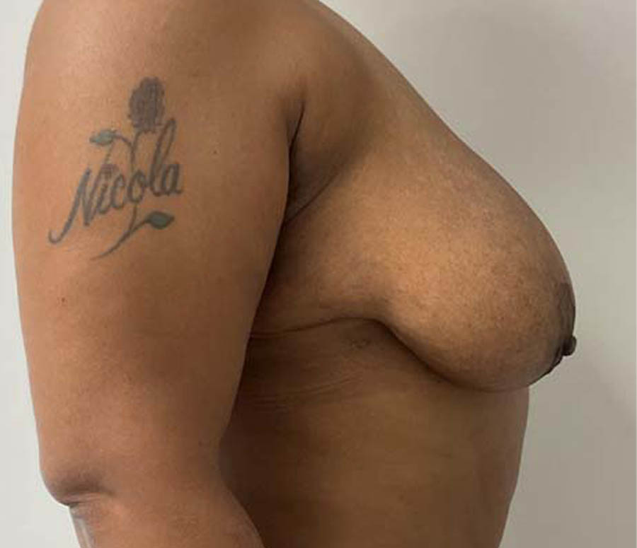 Breast Reduction before and after - before