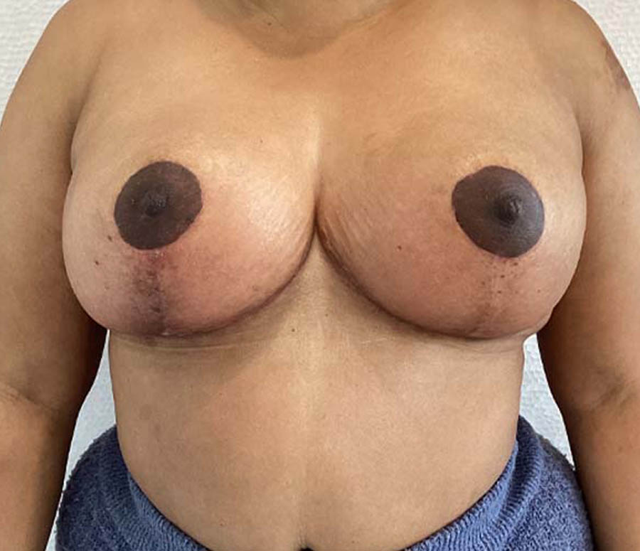 Breast Reduction before and after - after