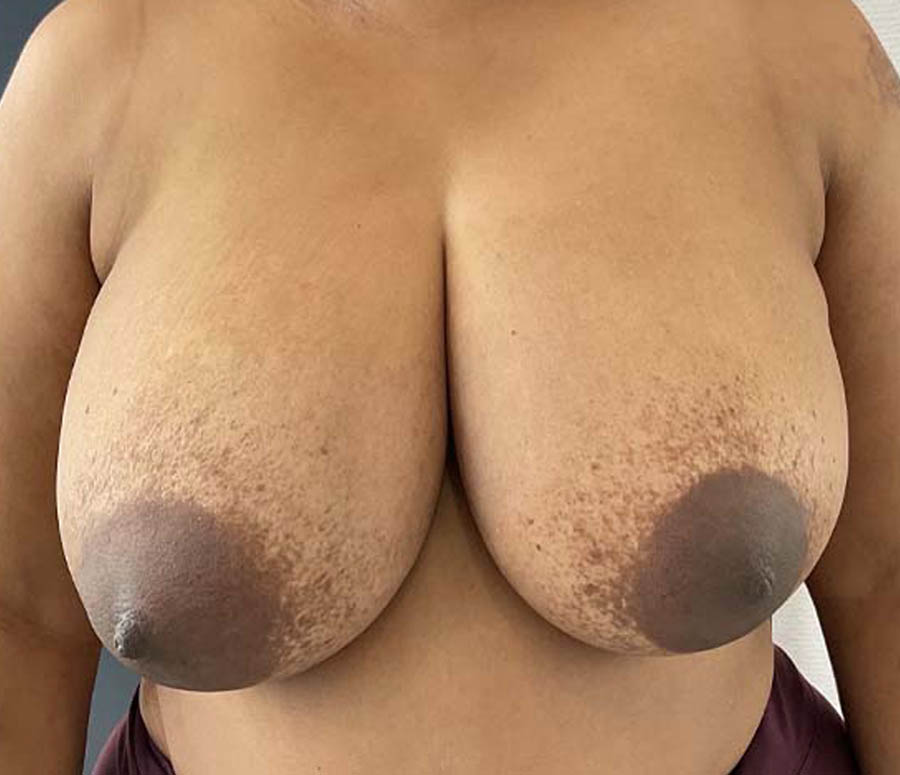 Breast Reduction before and after - before