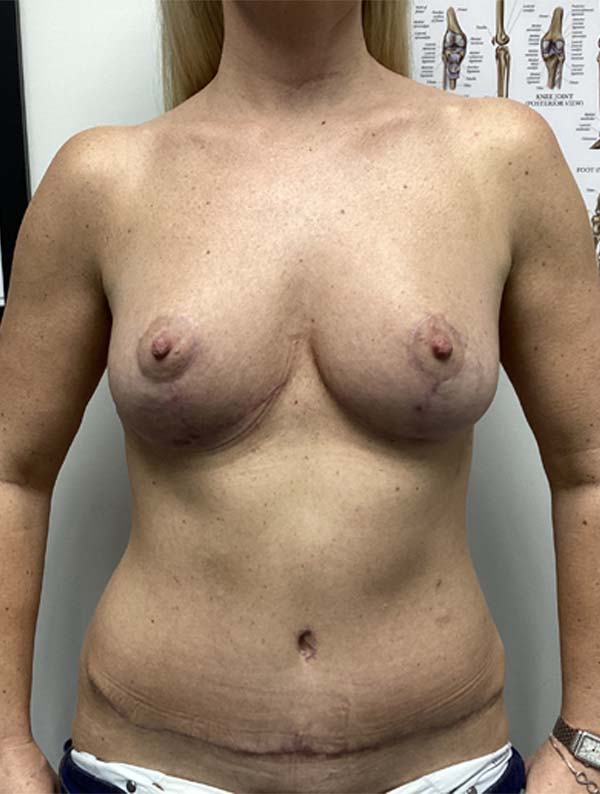 Mommy Makeover before and after - after