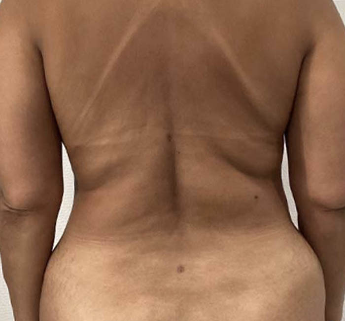 Liposuction before and after - before