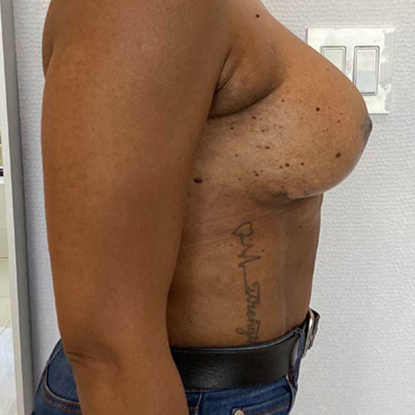 Breast Augmentation before and after - after