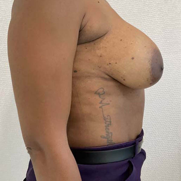 Breast Augmentation before and after - before
