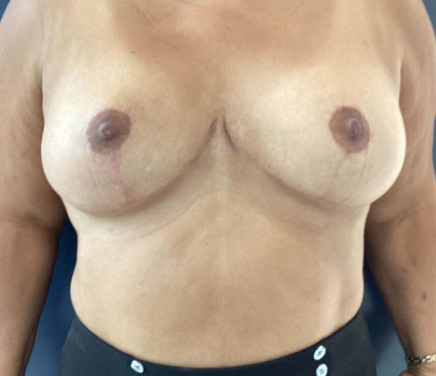 Breast Reduction before and after - after