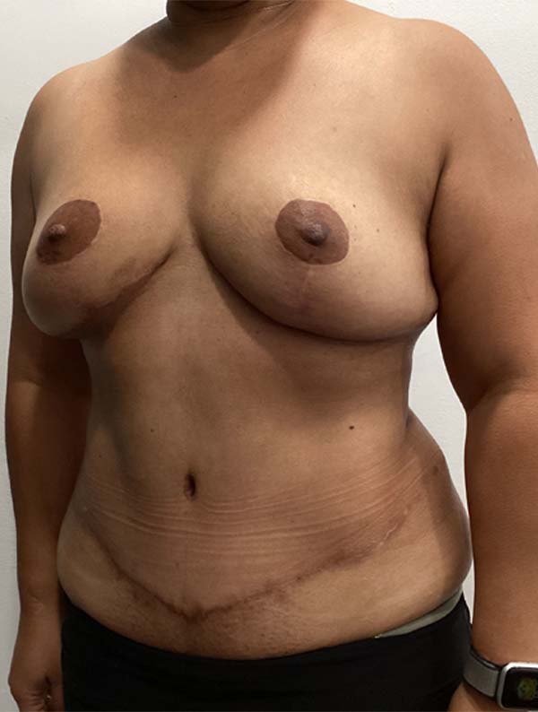 Mommy Makeover before and after - after