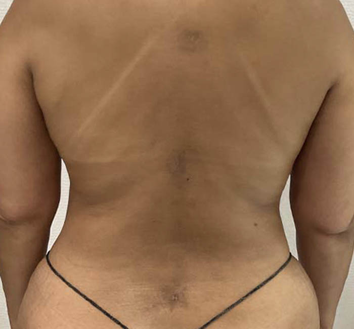 Liposuction before and after - after