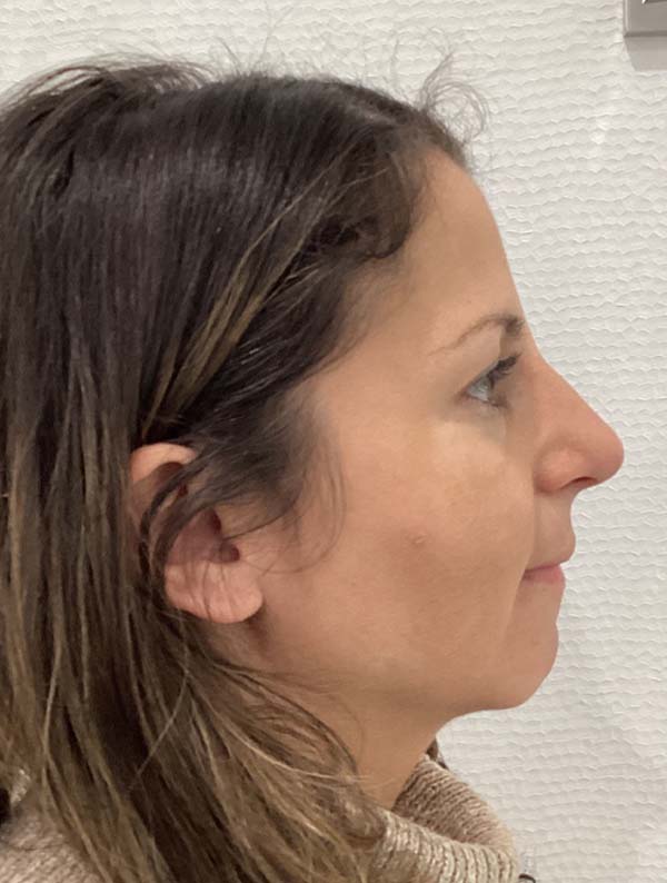 Rhinoplasty before and after - after