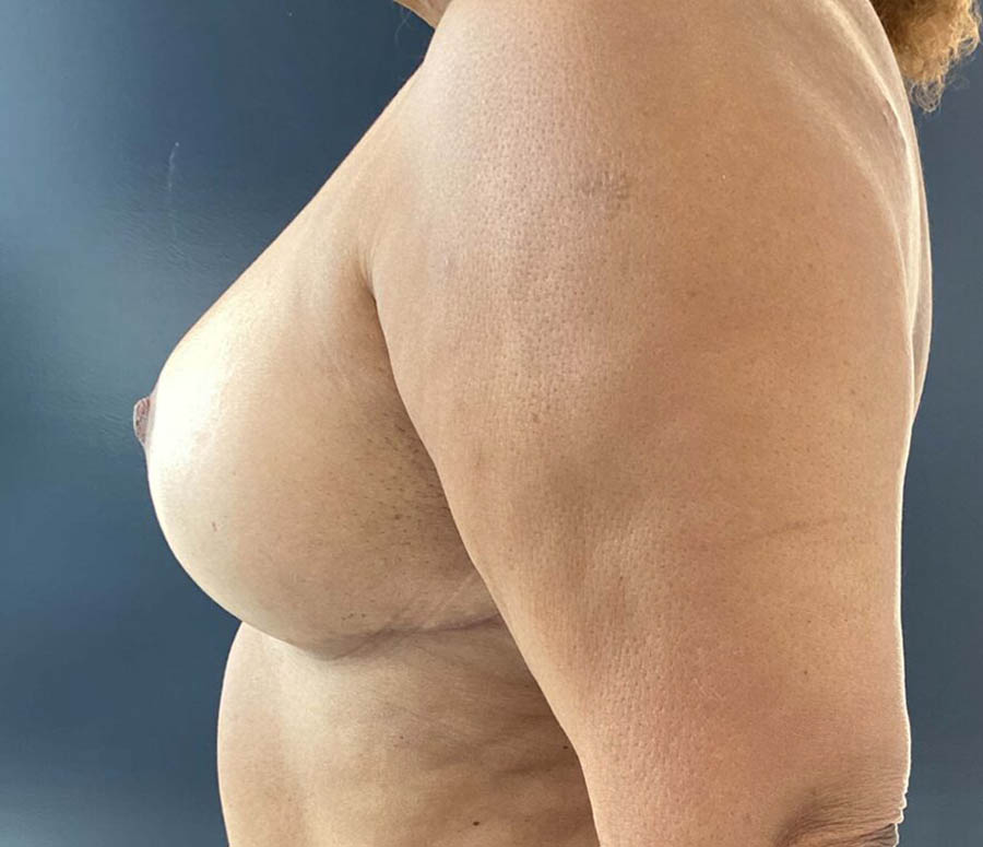 Breast Reduction before and after - after