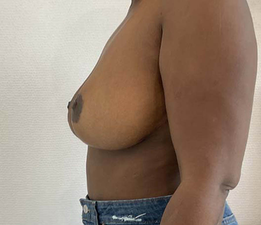 Breast Reduction before and after - after