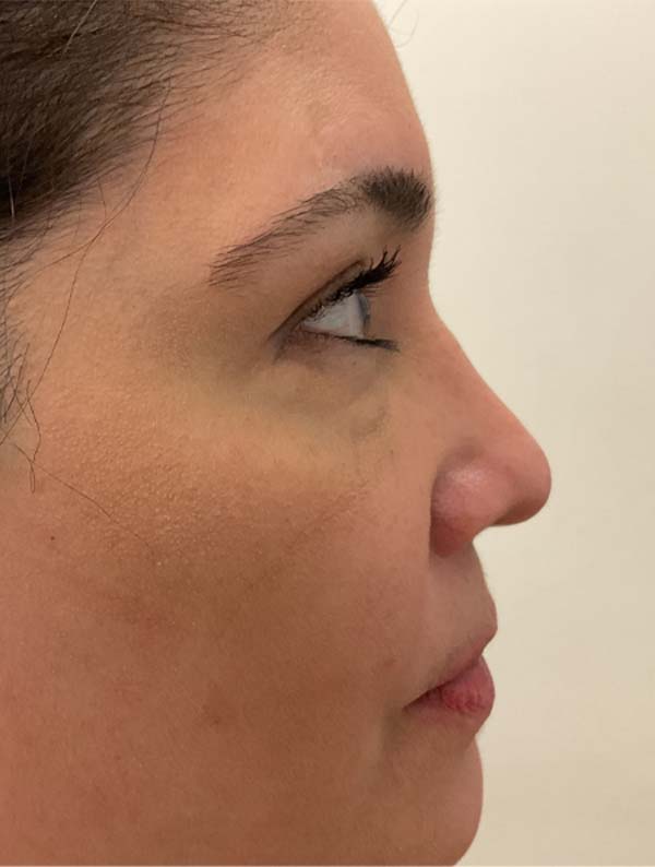 Rhinoplasty before and after - after