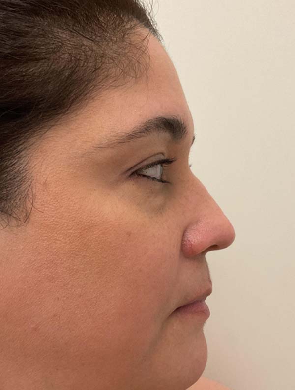 Rhinoplasty before and after - before