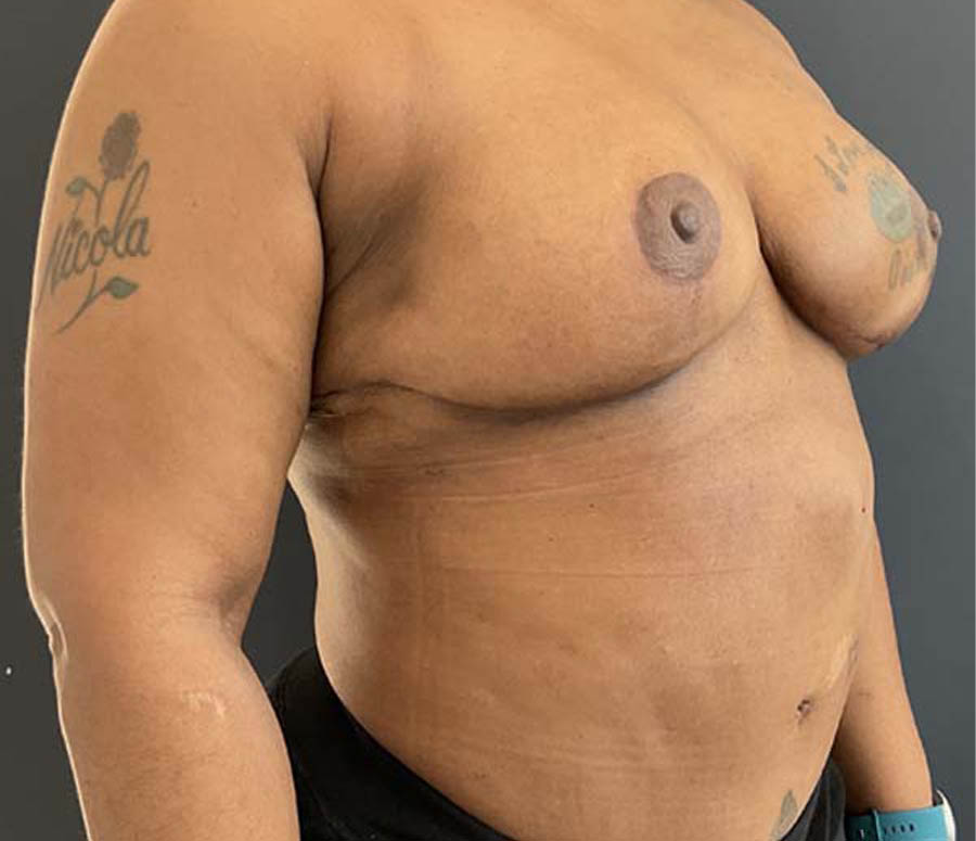 Breast Reduction before and after - after