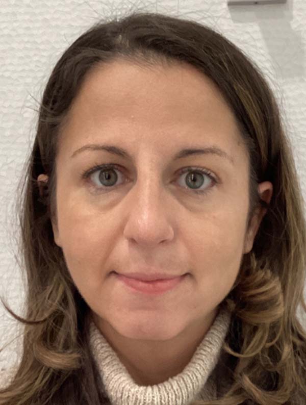 Rhinoplasty before and after - after