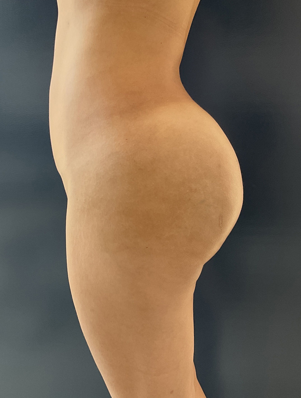 Procedure before and after - after