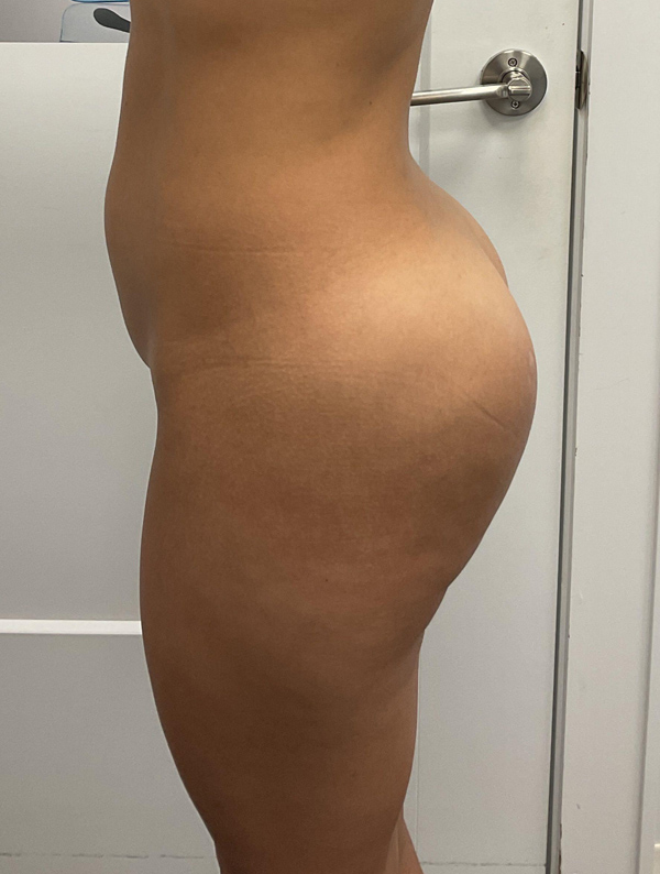 Procedure before and after - before