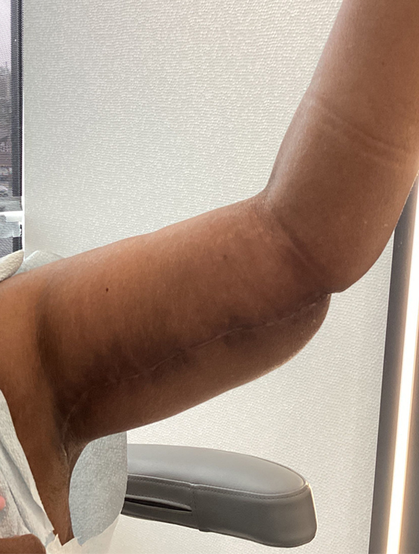 Arm Lift after — Dr. Jeremy Nikfarjam