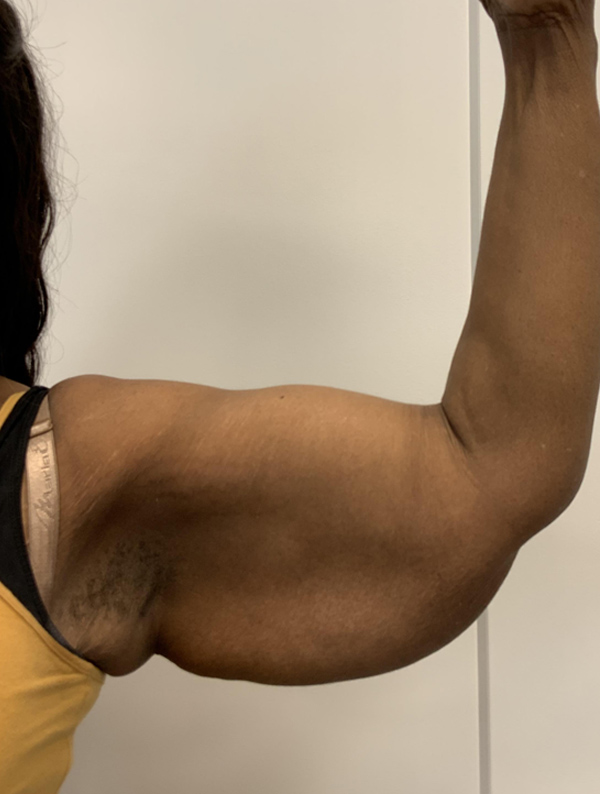 Arm Lift before — Dr. Jeremy Nikfarjam