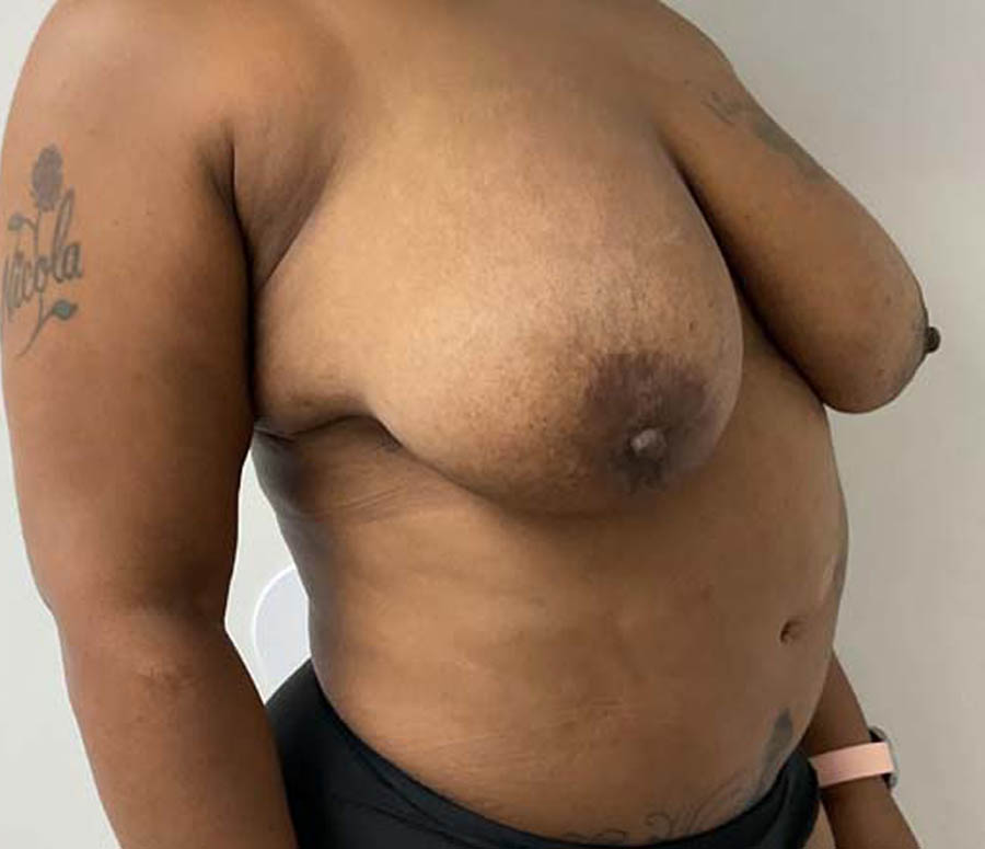 Breast Reduction before and after - before