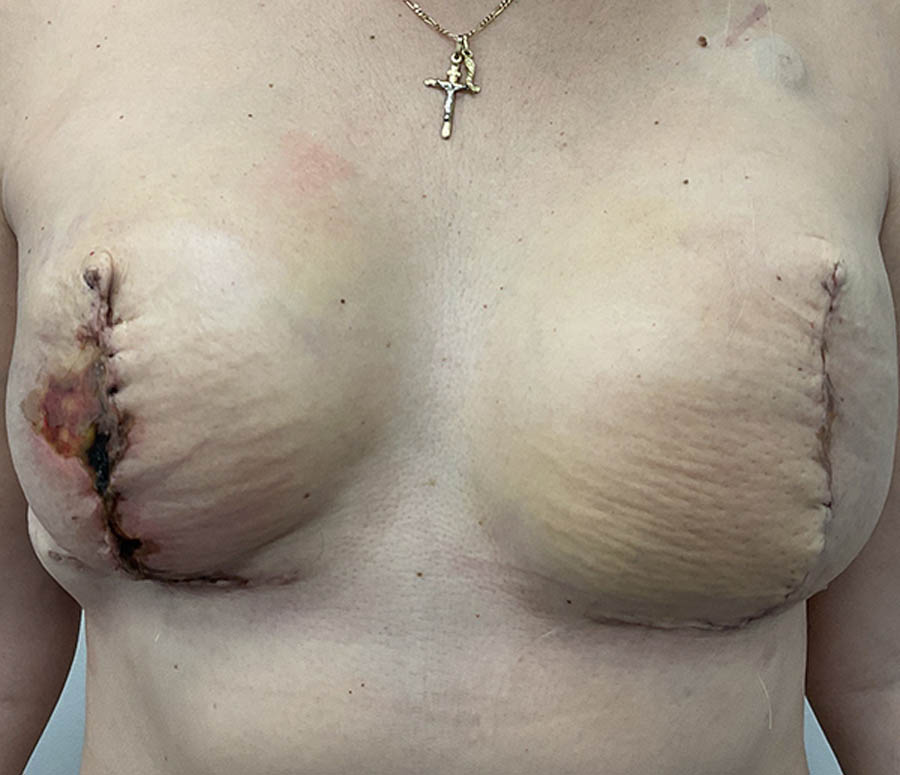 Breast Reconstruction before — Dr. Jeremy Nikfarjam