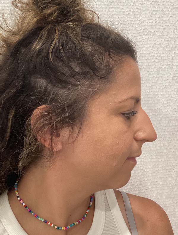 Rhinoplasty before and after - before