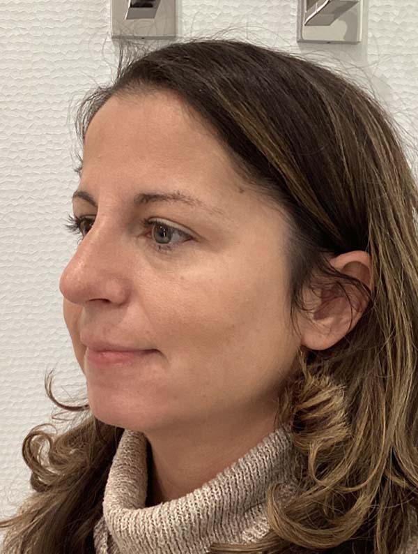 Rhinoplasty before and after - after