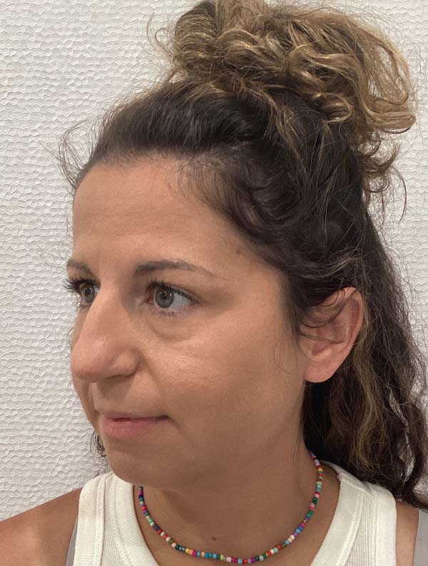 Rhinoplasty before and after - before