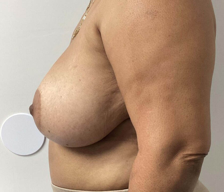 Breast Reduction before and after - before