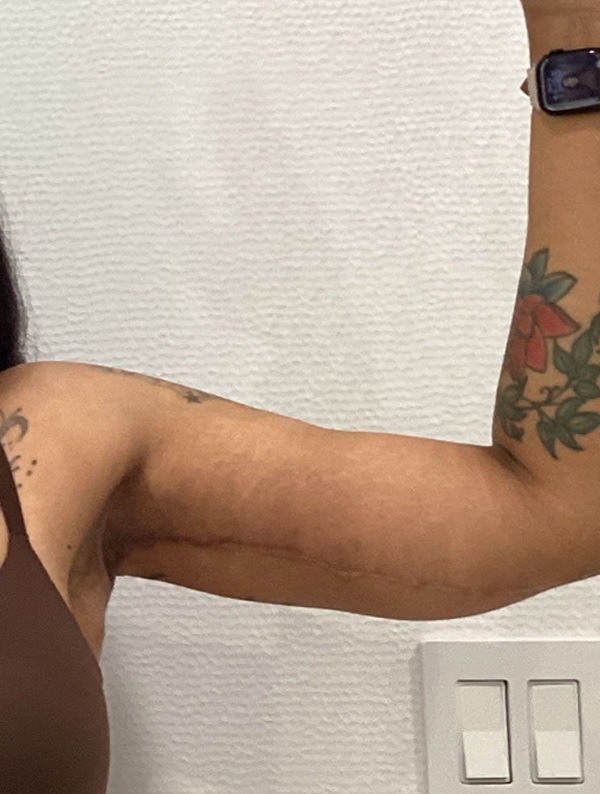 Arm Lift after — Dr. Jeremy Nikfarjam