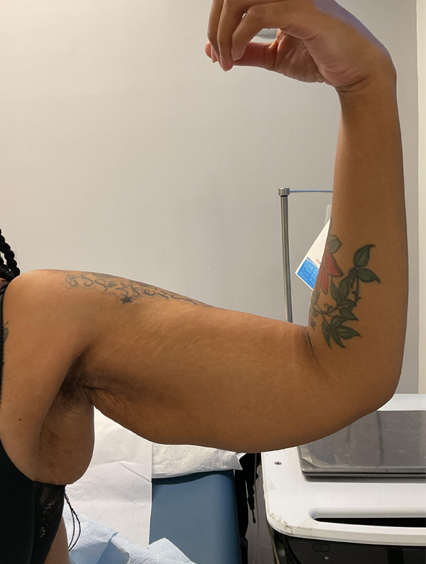 Arm Lift before — Dr. Jeremy Nikfarjam