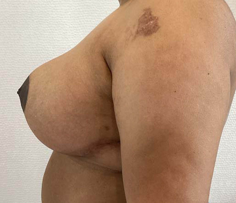 Breast Reduction before and after - after