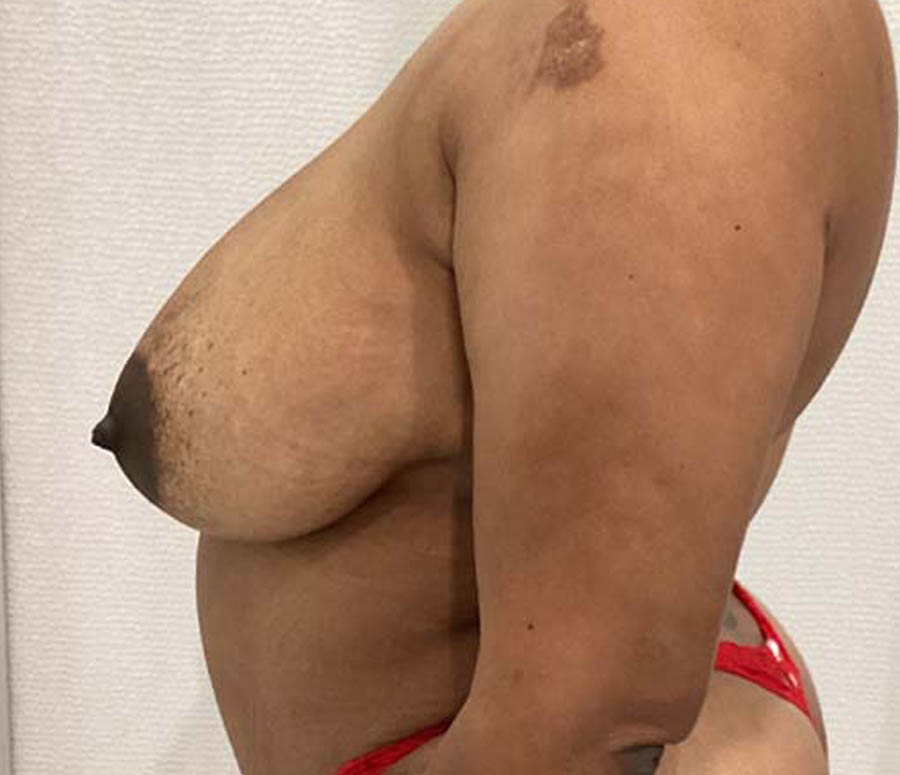 Breast Reduction before and after - before