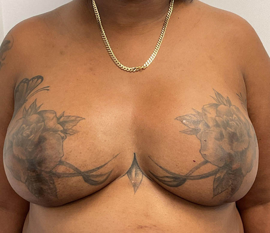 Breast Reconstruction after — Dr. Jeremy Nikfarjam