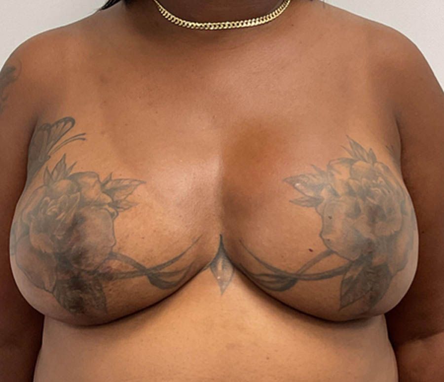 Breast Reconstruction before — Dr. Jeremy Nikfarjam