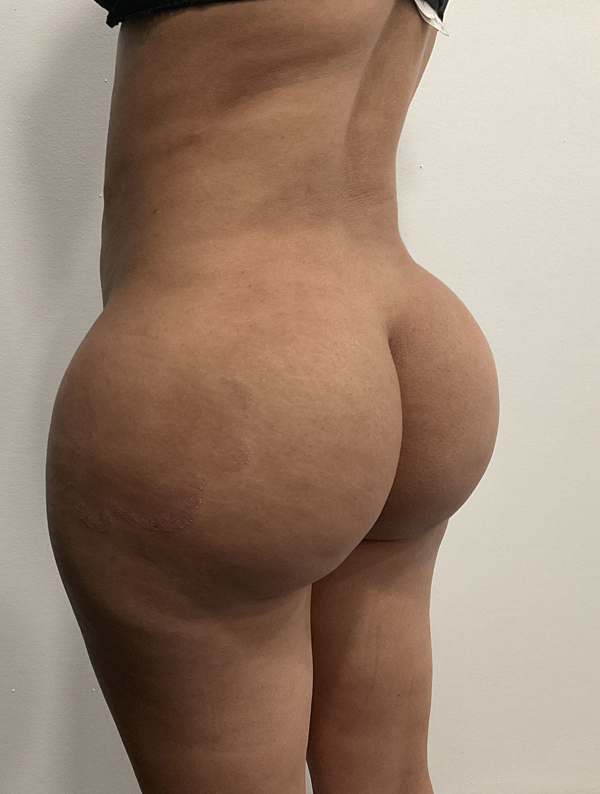 Procedure before and after - before