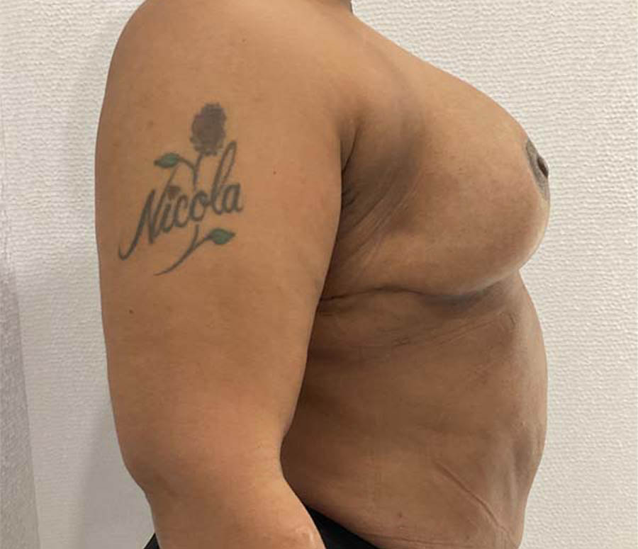 Breast Reduction before and after - after