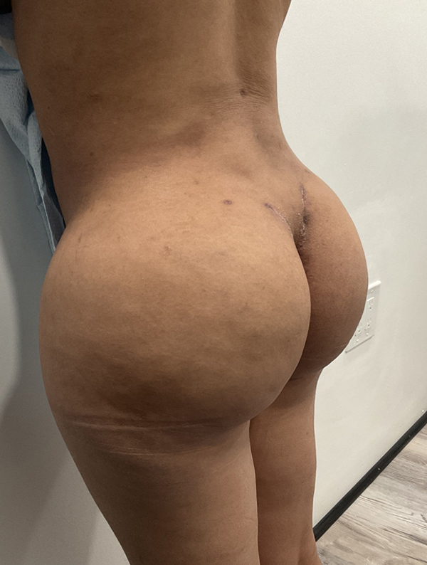 Procedure before and after - after