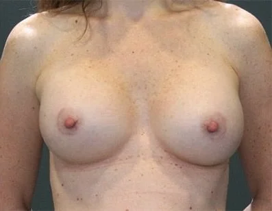 Breast Augmentation before and after - after