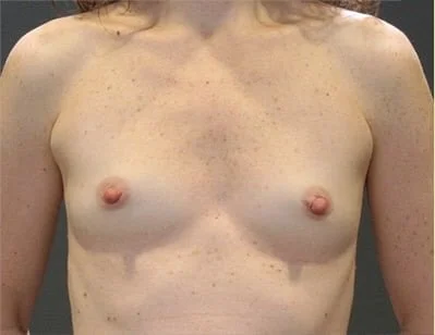 Breast Augmentation before and after - before