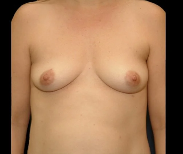 Breast Augmentation before and after - after